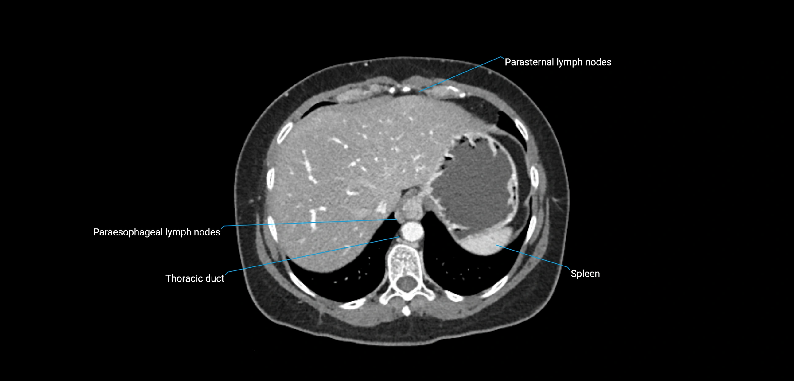 CT ct abdominal lymph nodes  axial cross sectional anatomy  enchanced radiology image -img-00002-00085.webp